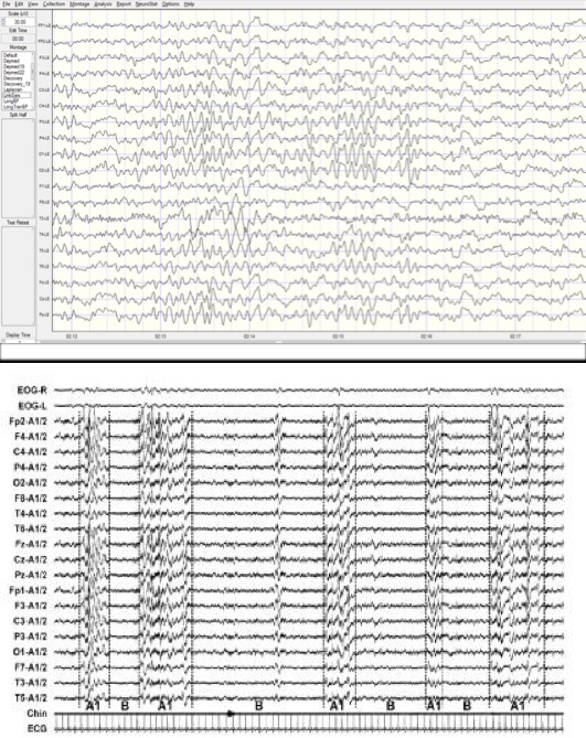eeg-2